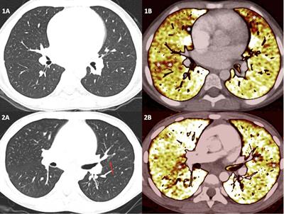 Dual-energy computed tomography to detect early pulmonary vascular changes in children with sickle cell disease: a pilot study